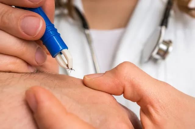 Jak wyjmować kleszcze - skuteczne metody, które zmniejszają ryzyko zakażenia Jak wyjmować kleszcze - skuteczne metody, które zmniejszają ryzyko zakażenia
